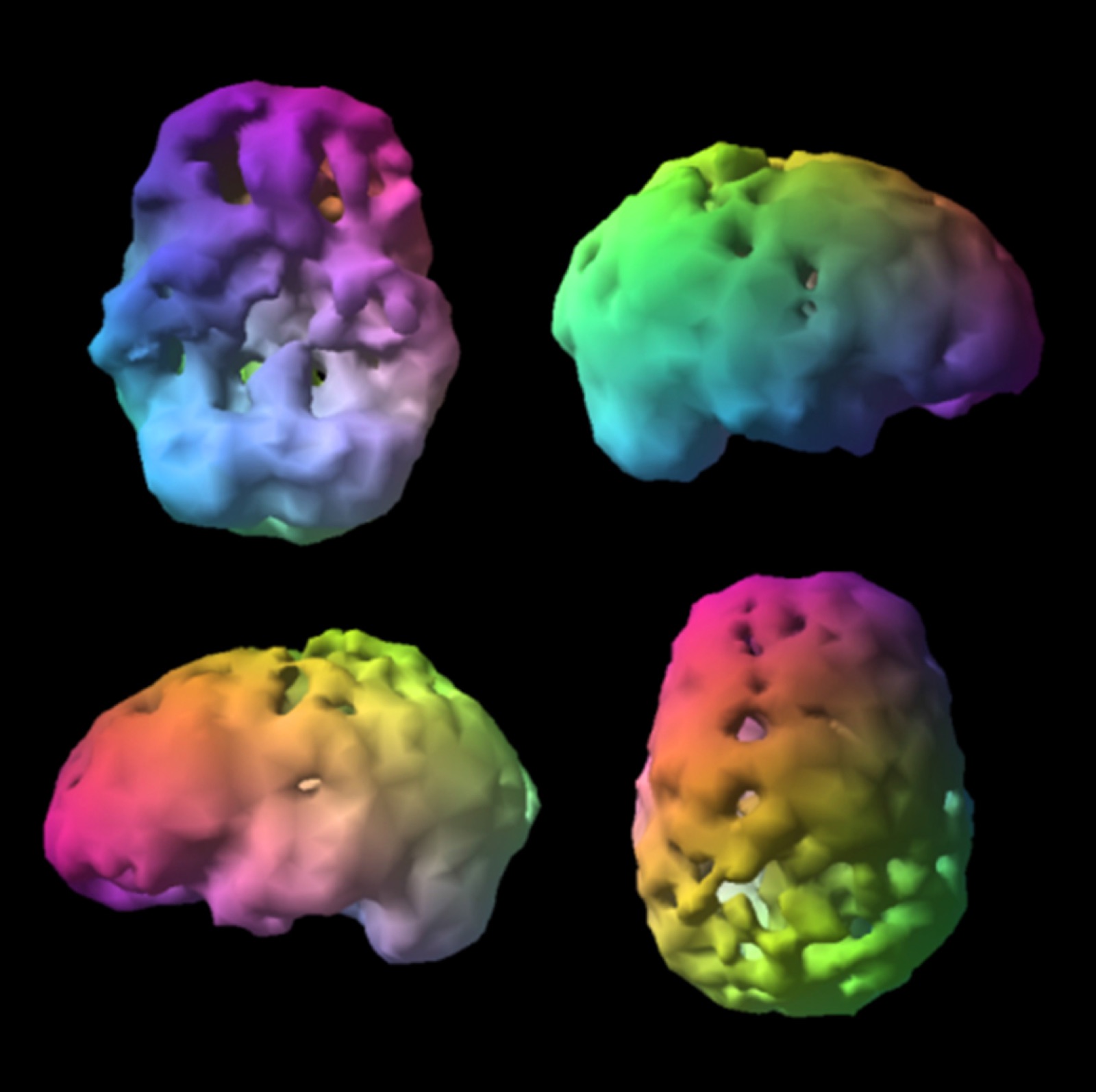 Unhealthy brain SPECT scan